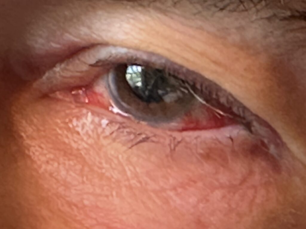 Bloodshot eye after eye surgery 